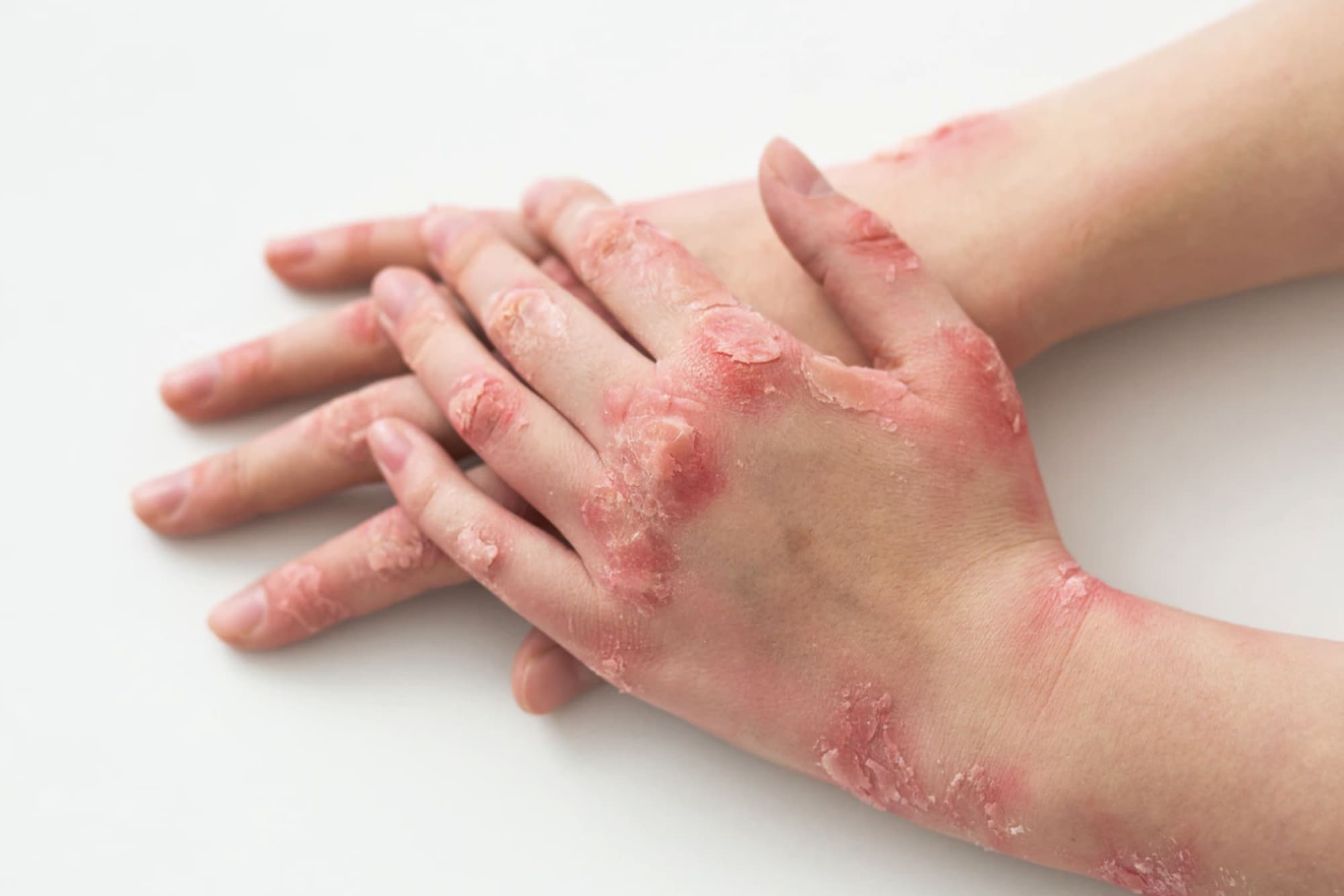 Artritis Psoriásica en CDMX