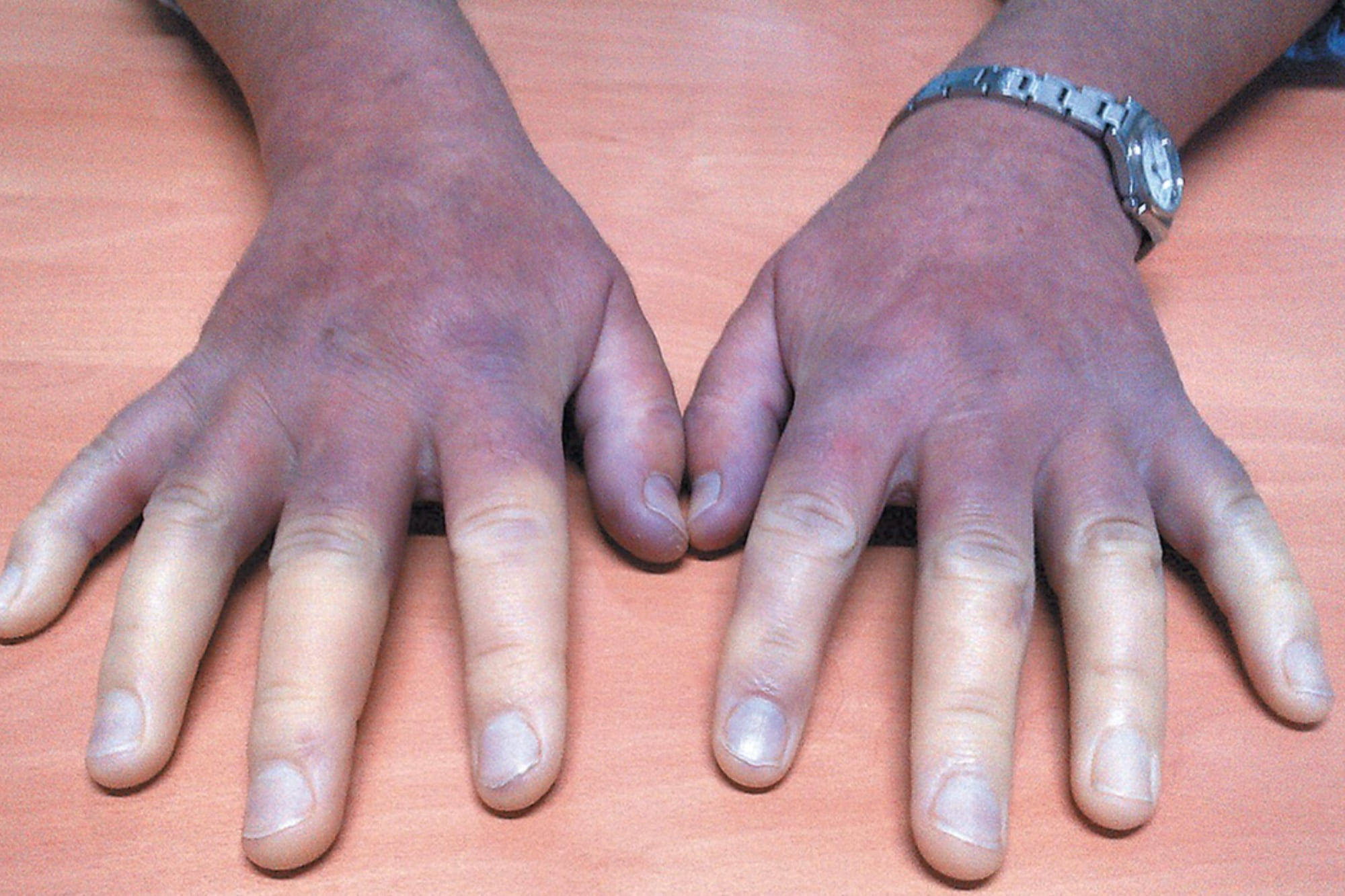 Esclerosis Sistémica en CDMX