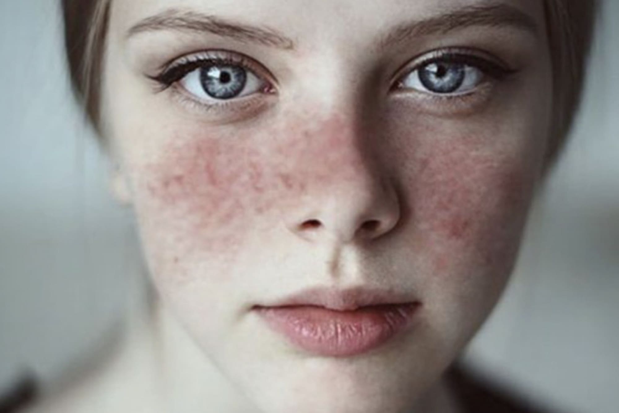 Lupus Eritematoso Sistémico en CDMX