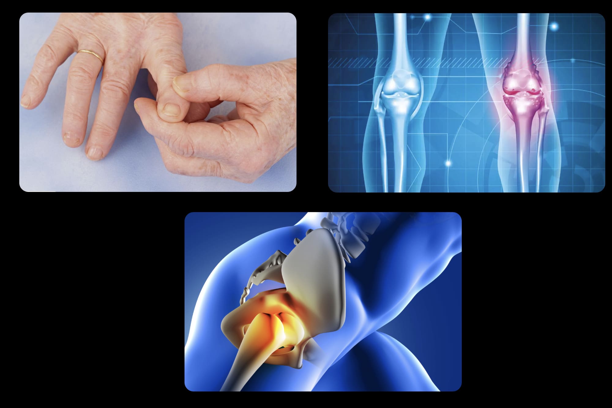 Osteoartritis o Artrosis en CDMX