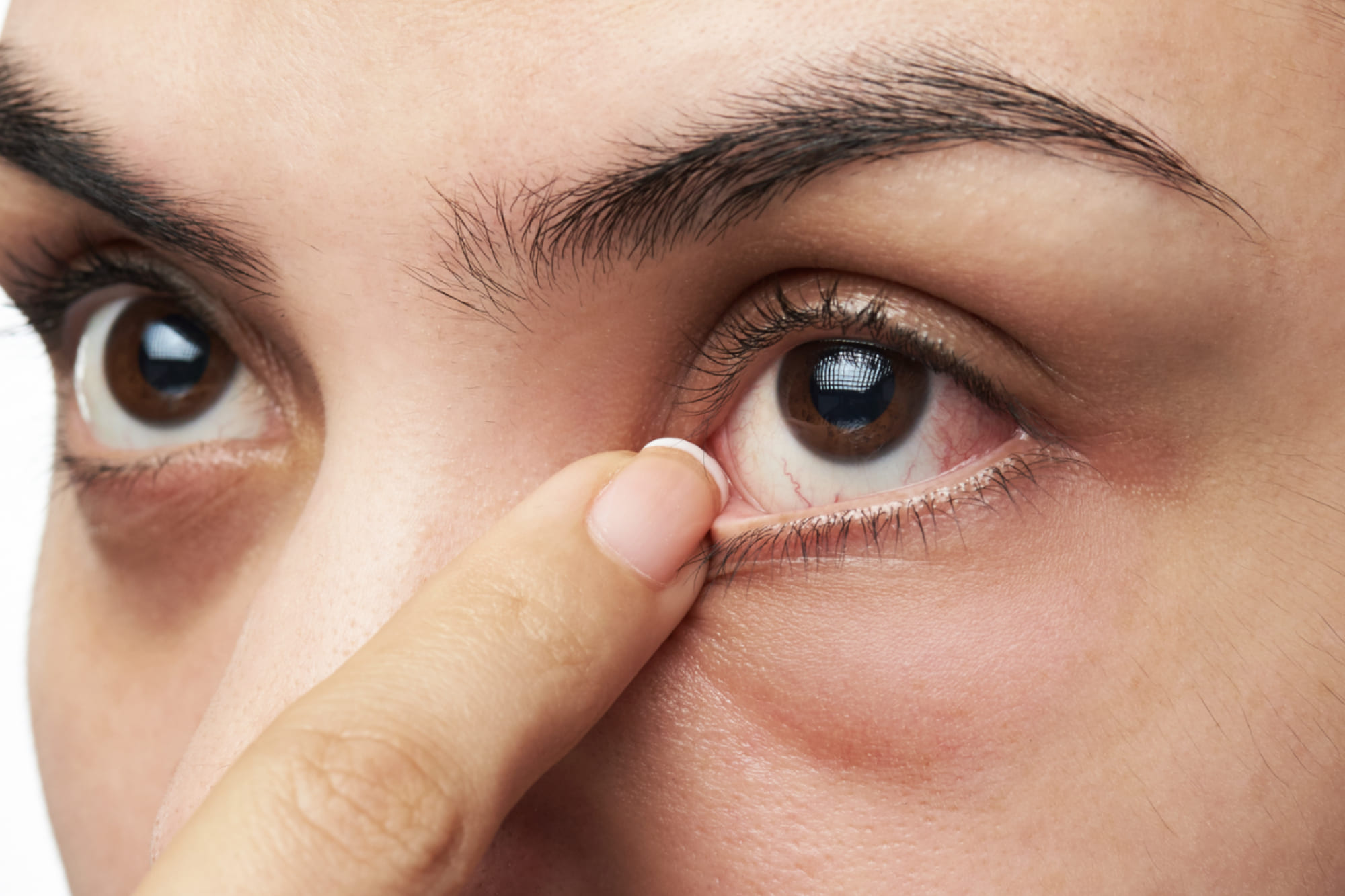 Síndrome de Sjögren en CDMX